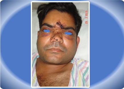 MAXILLOFACIAL INJURY